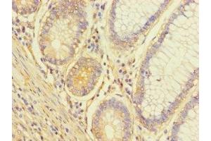 Immunohistochemistry of paraffin-embedded human colon cancer using ABIN7174650 at dilution of 1:100 (ALG14 Antikörper  (AA 25-216))