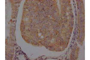 IHC image of ABIN7127366 diluted at 1:100 and staining in paraffin-embedded human endometrial cancer performed on a Leica BondTM system.