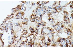 Immunohistochemistry of paraffin-embedded Human thyroid cancer using NUBP1 Polyclonal Antibody at dilution of 1:100 (40x lens). (NUBP1 Antikörper)