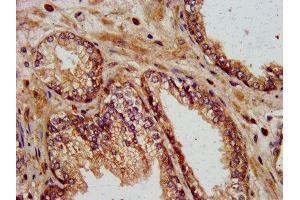 IHC image of ABIN7157591 diluted at 1:400 and staining in paraffin-embedded human prostate cancer performed on a Leica BondTM system. (KIF13B Antikörper  (AA 1531-1701))