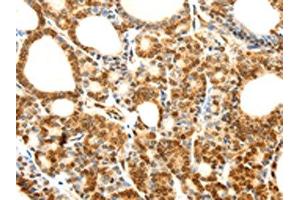 The image on the left is immunohistochemistry of paraffin-embedded Human thyroid cancer tissue using ABIN7128859(CDH23 Antibody) at dilution 1/80, on the right is treated with fusion protein. (CDH23 Antikörper)