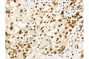 Phospho-SMC1 (Ser957) Antibody at 1/100 staining Human ovarian cancer by IHC-P. (SMC1A Antikörper  (pSer957))