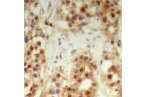 Immunohistochemical analysis of NXF3 staining in human breast cancer formalin fixed paraffin embedded tissue section. (NXF3 Antikörper)