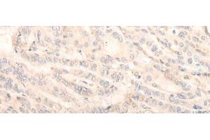 Immunohistochemistry of paraffin-embedded Human thyroid cancer tissue using INPP1 Polyclonal Antibody at dilution of 1:35(x200) (INPP1 Antikörper)