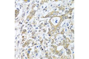 Immunohistochemistry of paraffin-embedded human gastric cancer using TICAM1 antibody (ABIN6292306) at dilution of 1:100 (40x lens).