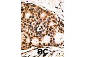 Formalin-fixed and paraffin-embedded human cancer tissue reacted with CDX1 polyclonal antibody  , which was peroxidase-conjugated to the secondary antibody, followed by AEC staining. (CDX1 Antikörper  (C-Term))
