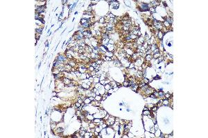 Immunohistochemistry of paraffin-embedded Human colon carcinoma using GULP1 Rabbit pAb (ABIN6131564, ABIN6141541, ABIN6141542 and ABIN6220256) at dilution of 1:100 (40x lens). (GULP1 Antikörper  (AA 1-130))