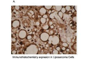 Immunohistochemical staining of human liposarcoma cells using CYP4F11 antibody . (CYP4F11 Antikörper  (C-Term))