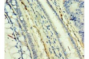 Immunohistochemistry of paraffin-embedded human colon cancer using ABIN7171470 at dilution of 1:100 (TAF5L Antikörper  (AA 1-325))