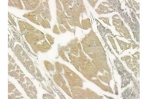 ABIN6264963 and ABIN6273315 at 1/100 staining human tongue carcinoma by IHC-P. (SEC63 Antikörper  (C-Term))