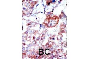 Formalin-fixed and paraffin-embedded human cancer tissue reacted with Ilk polyclonal antibody  , which was peroxidase-conjugated to the secondary antibody, followed by AEC staining. (ILK Antikörper  (N-Term))