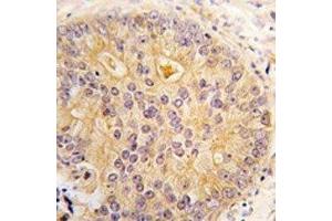 IHC analysis of FFPE human prostate carcinoma tissue stained with CAMKK2 antibody (CAMKK2 Antikörper  (AA 52-82))