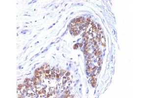 Formalin-fixed, paraffin-embedded human Breast Carcinoma stained with MUC-1 / EMA Mouse Monoclonal Antibody (MUC1/520). (MUC1 Antikörper)