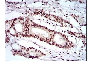 Immunohistochemical analysis of paraffin-embedded colon cancer tissues using KHDRBS2 mouse mAb with DAB staining.
