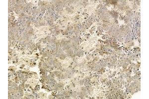 ABIN6259222 and ABIN6274419 at 1/100 staining human melanoma by IHC-P.