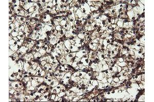 Immunohistochemical staining of paraffin-embedded Carcinoma of Human kidney tissue using anti-DOK7 mouse monoclonal antibody. (DOK7 Antikörper)