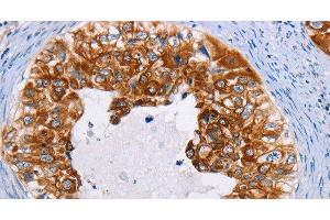 Immunohistochemistry of paraffin-embedded Human cervical cancer using CK-13 Polyclonal Antibody at dilution of 1:35 (Cytokeratin 13 Antikörper)