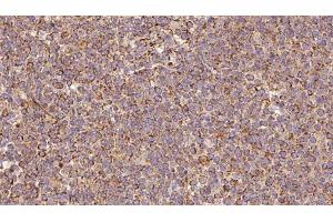 ABIN6273188 at 1/100 staining Human lymph cancer tissue by IHC-P. (Slc30a3 Antikörper  (C-Term))