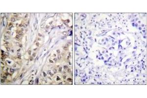 Immunohistochemistry analysis of paraffin-embedded human breast carcinoma tissue, using Survivin (Ab-117) Antibody. (Survivin Antikörper  (AA 86-135))
