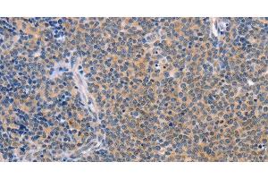 Immunohistochemistry of paraffin-embedded Human Lymphoma using CCL16 Polyclonal Antibody at dilution of 1:50 (CCL16 Antikörper)