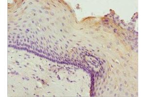 Immunohistochemistry of paraffin-embedded human cervical cancer using ABIN7176007 at dilution of 1:100 (ZNF187 Antikörper  (AA 239-478))