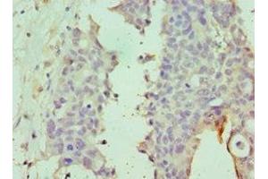 Immunohistochemistry of paraffin-embedded human endometrial cancer using ABIN7149988 at dilution of 1:100 (DPP8 Antikörper  (AA 10-230))
