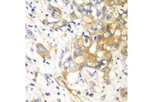 Immunohistochemistry of paraffin-embedded human liver cancer using KLK10 antibody at dilution of 1:100 (40x lens). (Kallikrein 10 Antikörper)