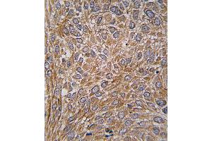 Formalin-fixed and paraffin-embedded human lung carcinoma tissue reacted with GIT1 Antibody  (ABIN391615 and ABIN2841536) , which was peroxidase-conjugated to the secondary antibody, followed by DAB staining. (GIT1 Antikörper  (AA 487-517))
