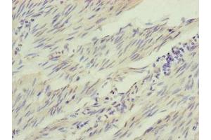Immunohistochemistry of paraffin-embedded human bladder cancer using ABIN7156905 at dilution of 1:100 (IL1F9 Antikörper  (AA 1-169))