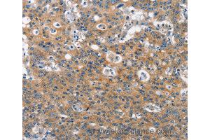 Immunohistochemistry of Human gastric cancer using CLTC Polyclonal Antibody at dilution of 1:60 (Clathrin Heavy Chain (CLTC) Antikörper)