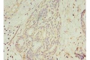 Immunohistochemistry of paraffin-embedded human breast cancer using ABIN7154452 at dilution of 1:100 (GCC1 Antikörper  (AA 4-775))