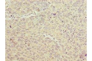 Immunohistochemistry of paraffin-embedded human cervical cancer using ABIN7153904 at dilution of 1:100 (PGM2L1 Antikörper  (AA 101-400))