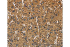 Immunohistochemistry of Human gastric cancer using CYP17A1 Polyclonal Antibody at dilution of 1:30 (CYP17A1 Antikörper)