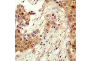 Immunohistochemical analysis of AKT2 (pS474) staining in human breast cancer formalin fixed paraffin embedded tissue section.