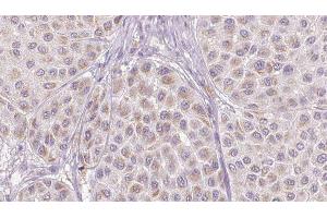ABIN6276733 at 1/100 staining Human melanoma tissue by IHC-P. (SERPINC1 Antikörper  (Internal Region))