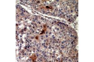 Immunohistochemical analysis of TRIF staining in human lung cancer formalin fixed paraffin embedded tissue section.