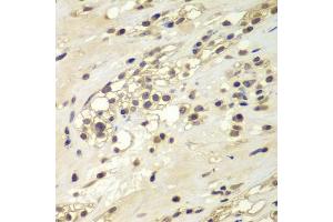 Immunohistochemistry of paraffin-embedded human kidney cancer using CHEK1 antibody. (CHEK1 Antikörper)