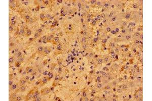Immunohistochemistry of paraffin-embedded human liver cancer using ABIN7162453 at dilution of 1:100 (P2RY1 Antikörper  (AA 329-373))