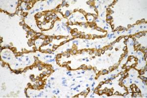 Immunohistochemistry was performed on paraffin-embedded human lung adenocarcinoma using keratin 7 antibody (ABIN7799188), 1:200). (Rekombinanter Cytokeratin 7 Antikörper)