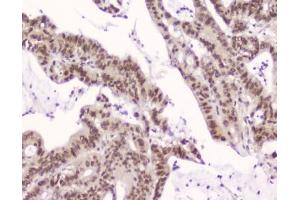 IHC testing of FFPE human intestinal cancer with XPO1 antibody at 2ug/ml. (XPO1 Antikörper  (AA 966-1071))