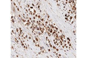 ABIN6266856 at 1/100 staining human Breast cancer tissue sections by IHC-P. (IRX2 Antikörper  (Internal Region))