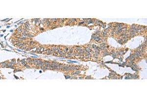 Immunohistochemistry of paraffin-embedded Human colorectal cancer tissue using HPCAL1 Polyclonal Antibody at dilution of 1:70(x200)