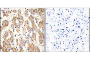 Immunohistochemistry analysis of paraffin-embedded human liver carcinoma, using BAX Antibody. (BAX Antikörper  (AA 41-90))