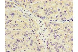 Immunohistochemistry of paraffin-embedded human liver cancer using ABIN7162964 at dilution of 1:100 (CROT Antikörper  (AA 1-87))