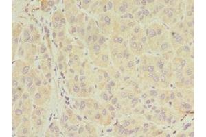 Immunohistochemistry of paraffin-embedded human liver cancer using ABIN7155026 at dilution of 1:100 (SERPIND1 Antikörper  (AA 20-290))