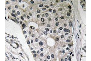 Immunohistochemistry analyzes of Ob antibody in paraffin-embedded human breast carcinoma tissue. (Leptin Antikörper)