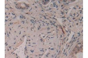 Detection of GAP43 in Human Pancreatic cancer Tissue using Polyclonal Antibody to Growth Associated Protein 43 (GAP43) (GAP43 Antikörper  (AA 1-274))