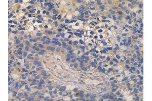 ABIN6260134 and ABIN6272480 at 1/100 staining human glioblastoma by IHC-P.
