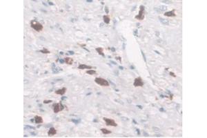 DAB staining on IHC-P Samples:Human Rectum Cancer Tissue. (SLC40A1 Antikörper  (AA 127-321))