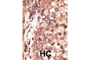 Formalin-fixed and paraffin-embedded human hepatocellular carcinoma tissue reacted with CREB3L1 polyclonal antibody  , which was peroxidase-conjugated to the secondary antibody, followed by DAB staining. (CREB3L1 Antikörper  (C-Term))